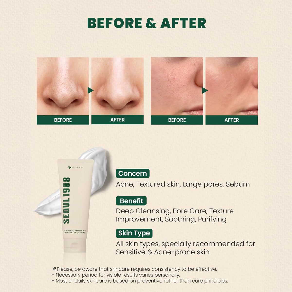 SEOUL 1988 Cleansing Foam : Pine Cica 1% + Probiotics